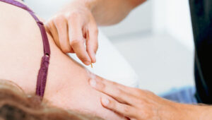 dry needling amsterdam west